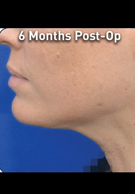 Renuvion Skin Tightening Before & After