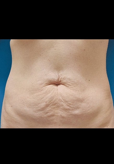 Renuvion Skin Tightening Before & After