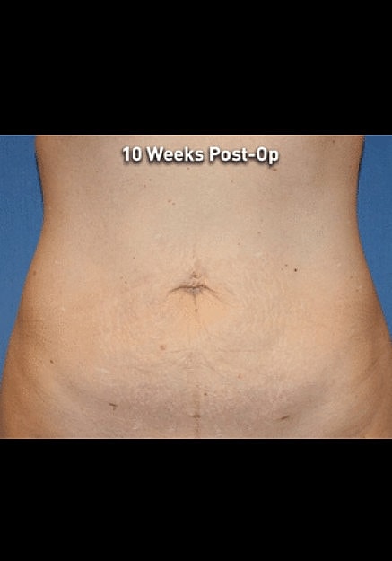 Renuvion Skin Tightening Before & After