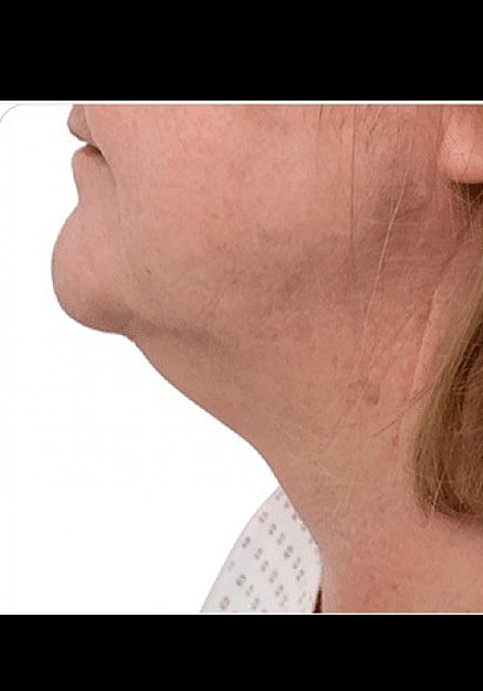 Renuvion Skin Tightening Before & After