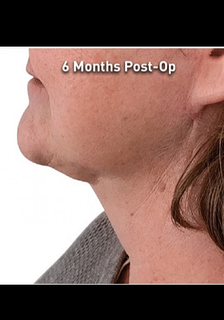 Renuvion Skin Tightening Before & After