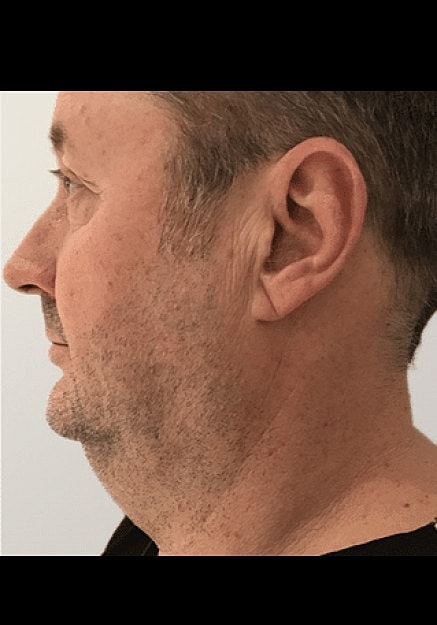 Renuvion Skin Tightening Before & After