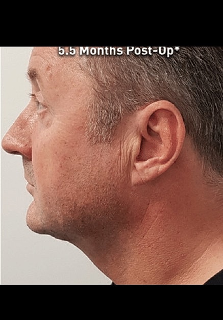 Renuvion Skin Tightening Before & After