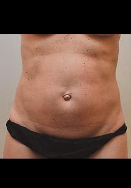 Renuvion Skin Tightening Before & After