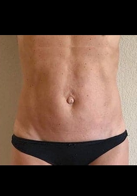 Renuvion Skin Tightening Before & After