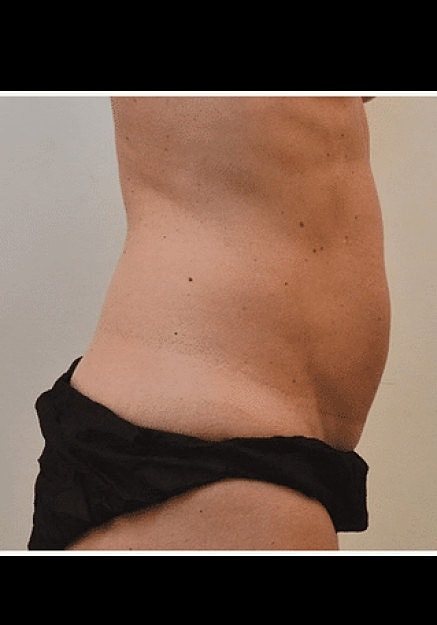 Renuvion Skin Tightening Before & After