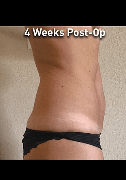 Renuvion Skin Tightening Before & After