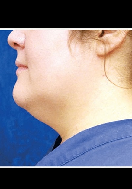 Renuvion Skin Tightening Before & After