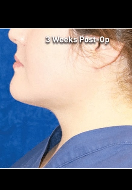 Renuvion Skin Tightening Before & After