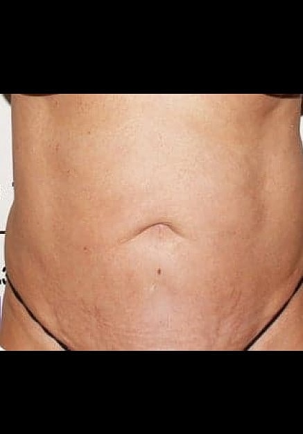 Renuvion Skin Tightening Before & After