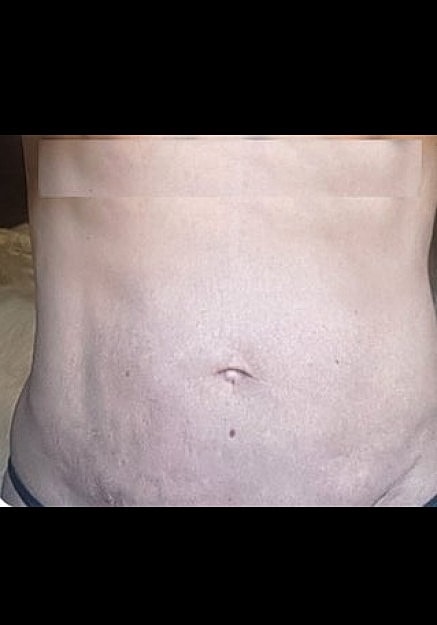 Renuvion Skin Tightening Before & After