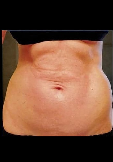 Renuvion Skin Tightening Before & After
