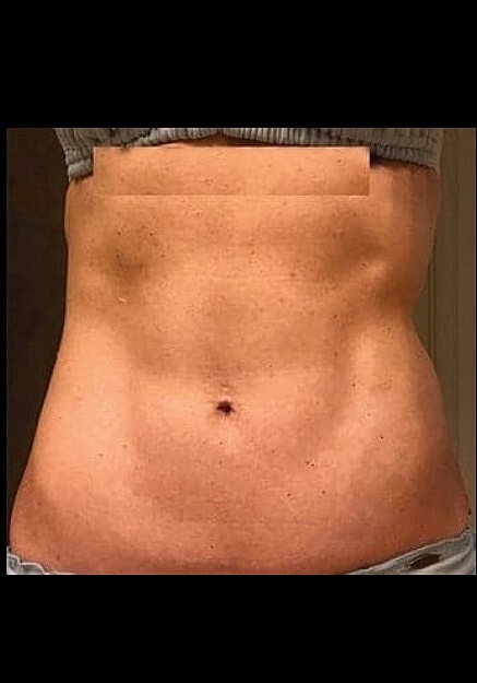 Renuvion Skin Tightening Before & After