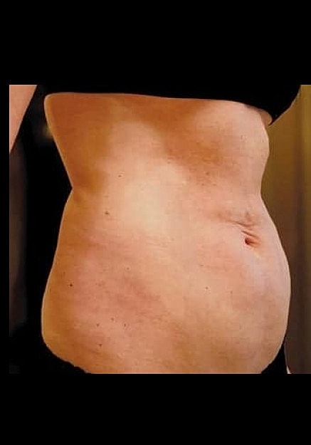 Renuvion Skin Tightening Before & After