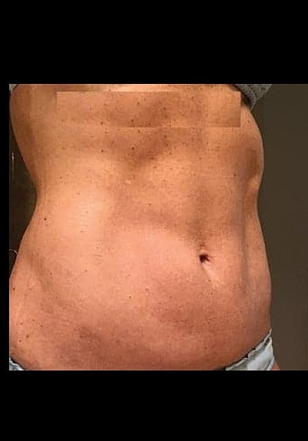 Renuvion Skin Tightening Before & After