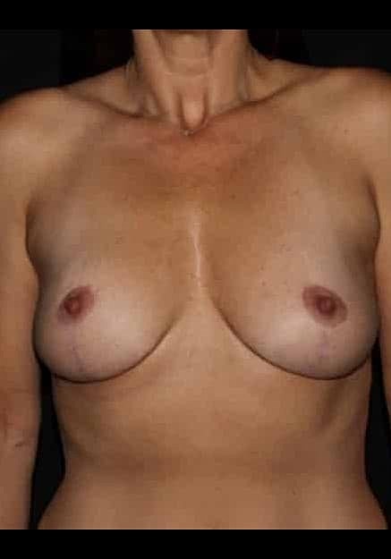Breast Implant Removal Before & After
