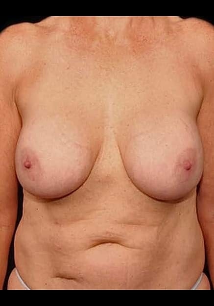 Breast Implant Removal Before & After