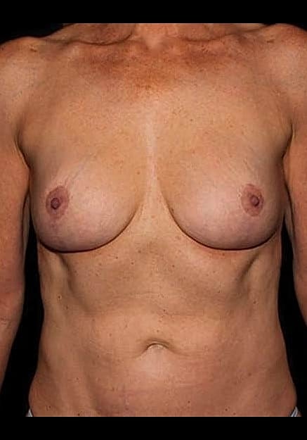 Breast Implant Removal Before & After