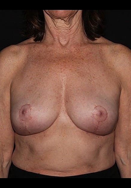 Breast Implant Removal Before & After