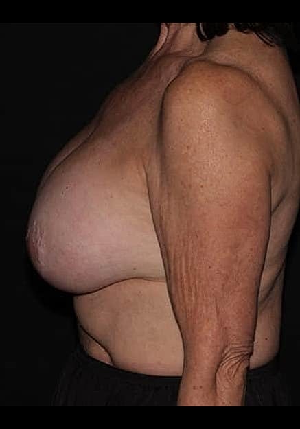 Breast Implant Removal Before & After