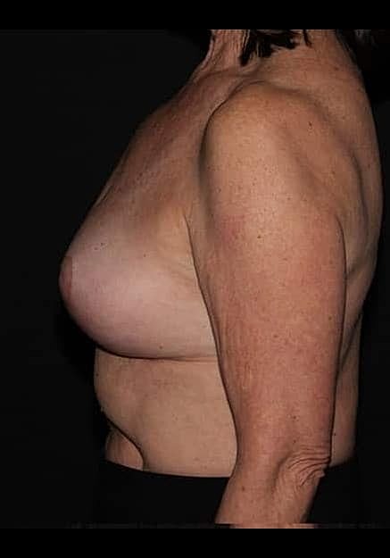 Breast Implant Removal Before & After