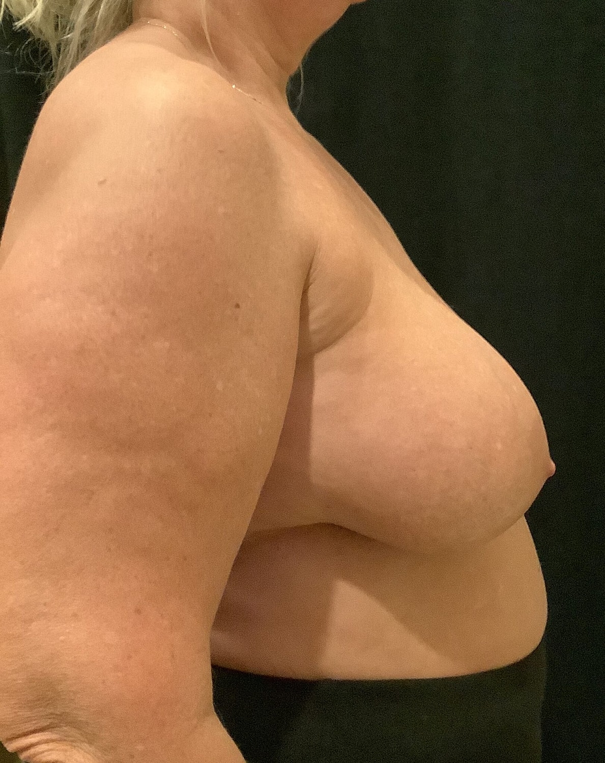 Breast Implant Removal Before & After