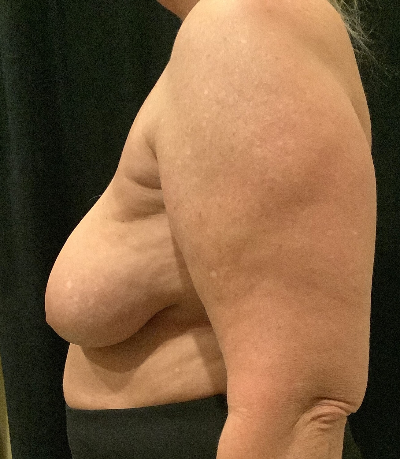 Breast Implant Removal Before & After