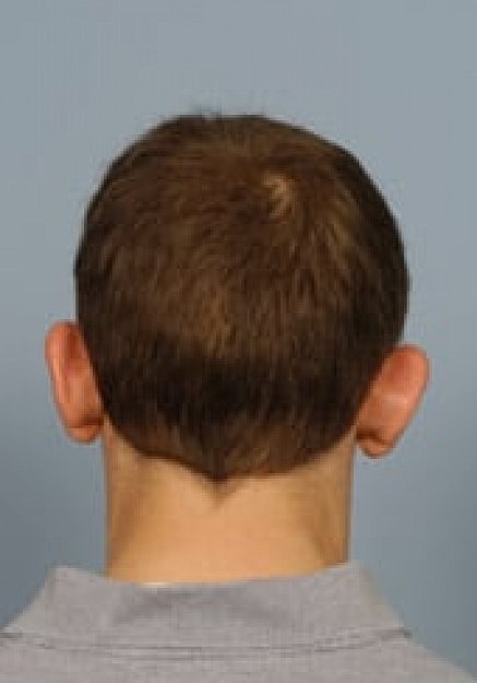 Ear Surgery Before & After