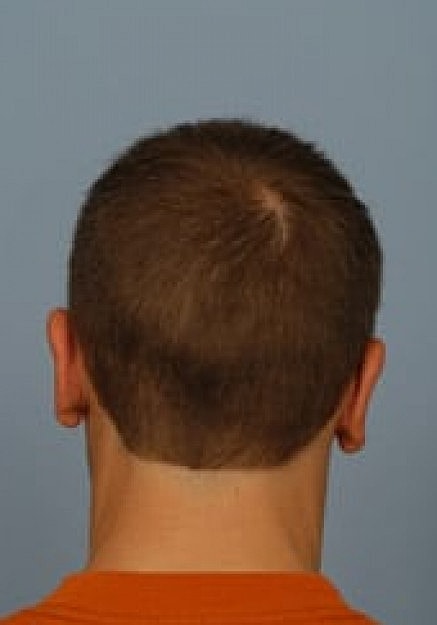 Ear Surgery Before & After