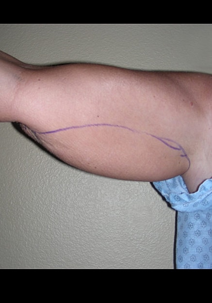 Vaser Liposelection Before & After
