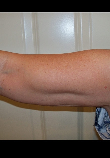 Vaser Liposelection Before & After