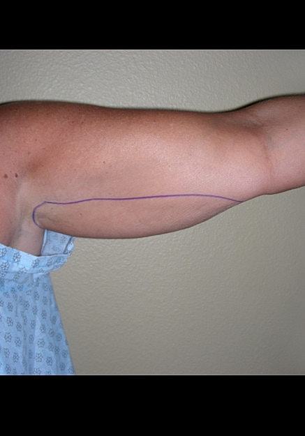 Vaser Liposelection Before & After