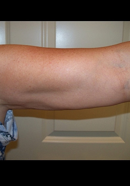 Vaser Liposelection Before & After