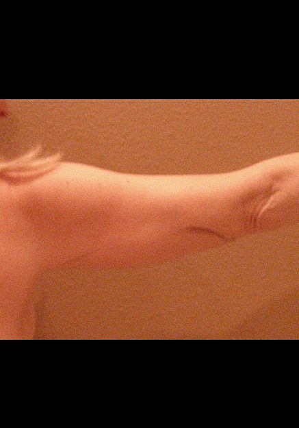 Vaser Liposelection Before & After