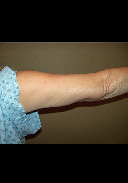Vaser Liposelection Before & After