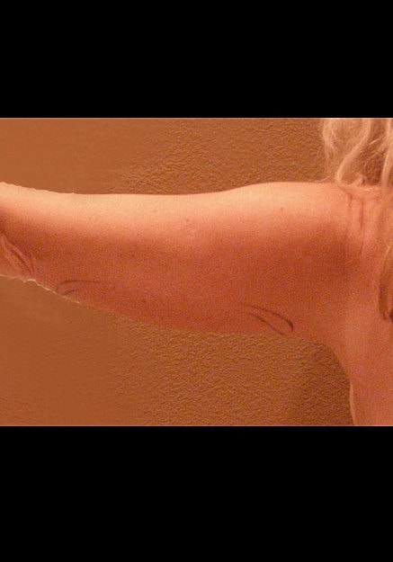 Vaser Liposelection Before & After