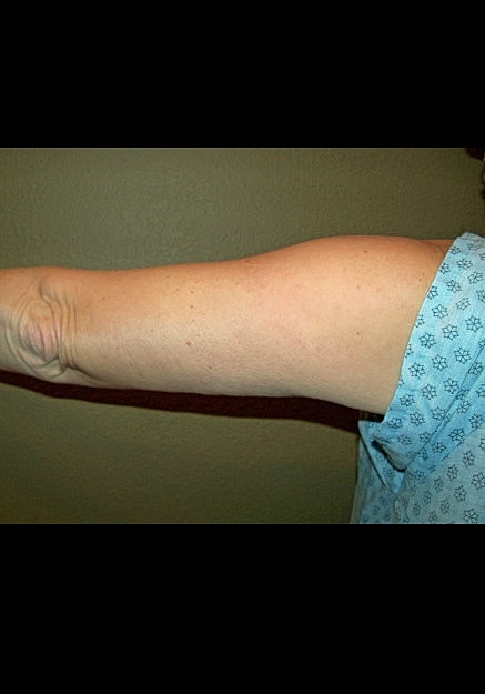 Vaser Liposelection Before & After