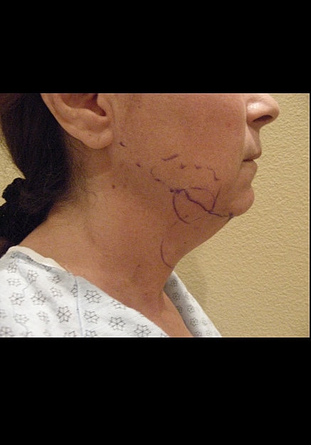 Vaser Liposelection Before & After