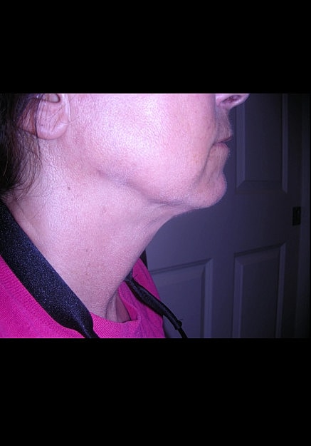 Vaser Liposelection Before & After