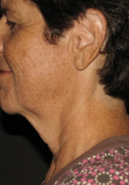 Vaser Liposelection Before & After
