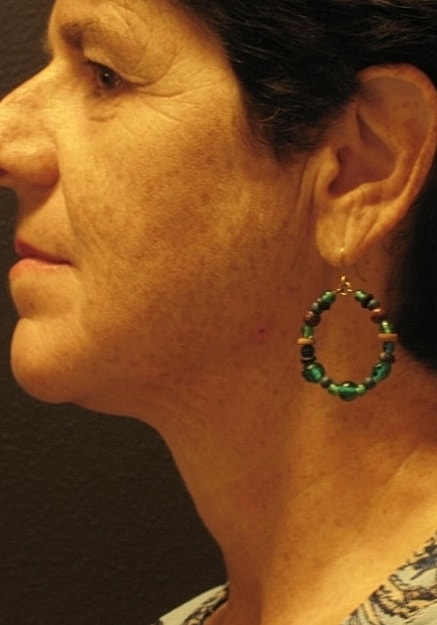 Vaser Liposelection Before & After