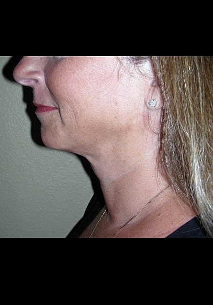 Vaser Liposelection Before & After