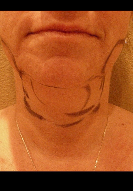 Vaser Liposelection Before & After