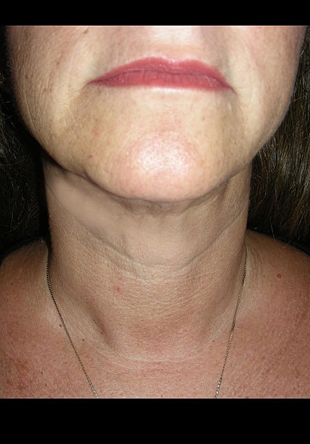 Vaser Liposelection Before & After