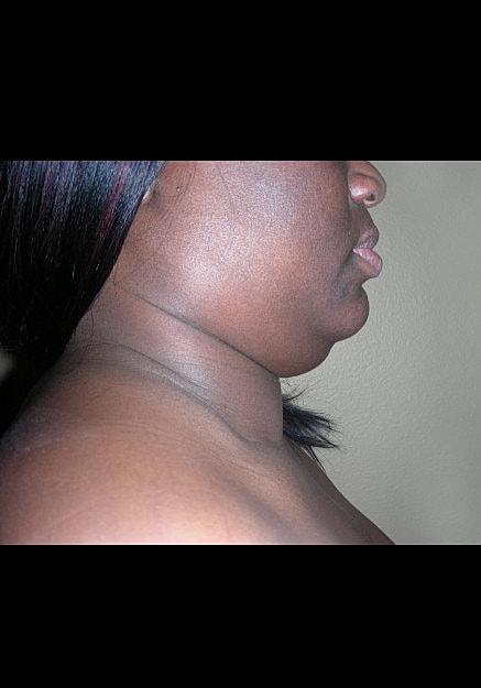 Vaser Liposelection Before & After