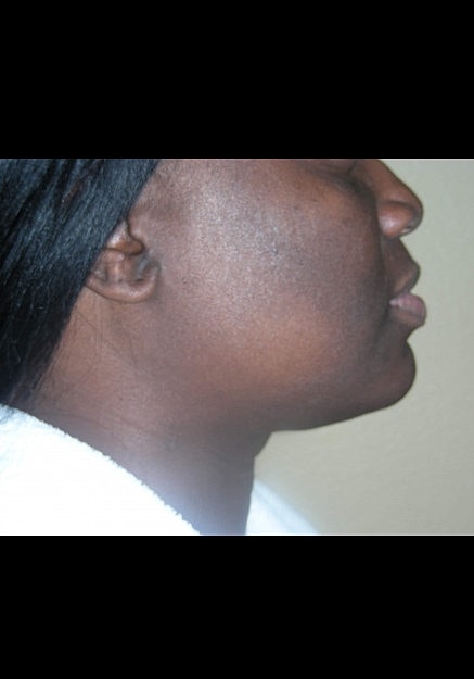 Vaser Liposelection Before & After