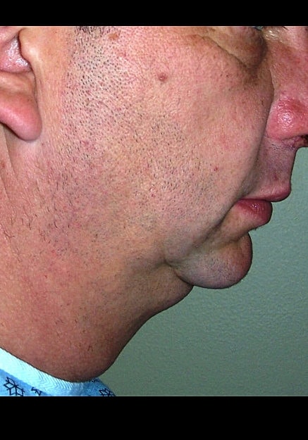 Vaser Liposelection Before & After