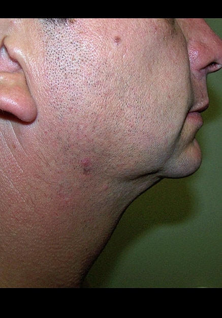Vaser Liposelection Before & After