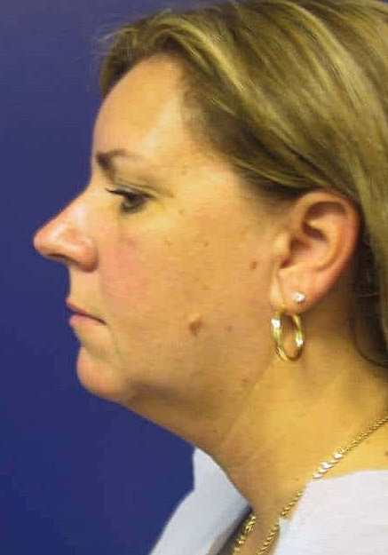 Vaser Liposelection Before & After
