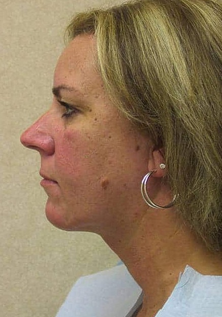 Vaser Liposelection Before & After